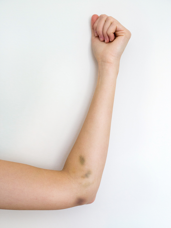 Bruised arm with raised clenched fist.